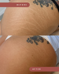 Simple Photocentric Before and After Instagram Story (Post para Instagram (45)) (1)