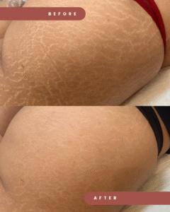 Simple Photocentric Before and After Instagram Story (Post para Instagram (45))